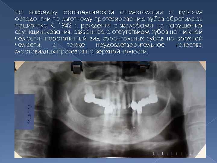 На кафедру ортопедической стоматологии с курсом ортодонтии по льготному протезированию зубов обратилась пациентка К.