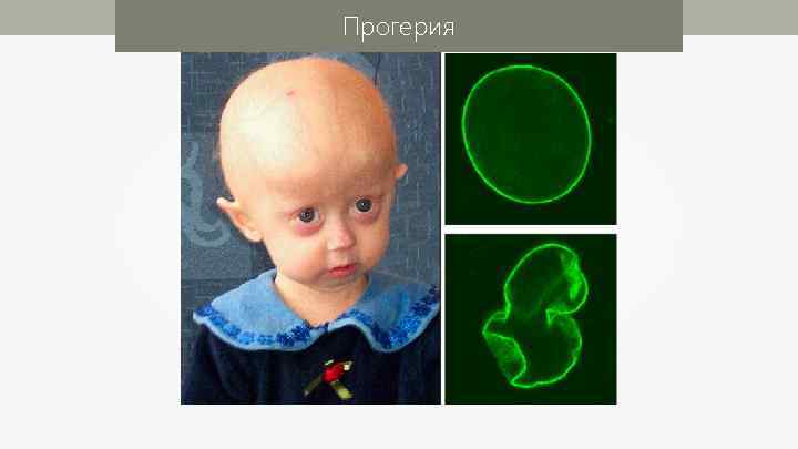Прогерия 