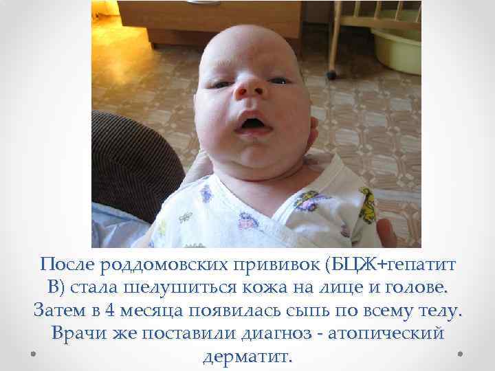 После роддомовских прививок (БЦЖ+гепатит В) стала шелушиться кожа на лице и голове. Затем в