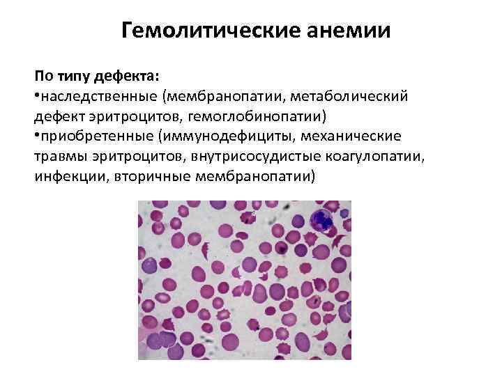 Врожденные гемолитические анемии