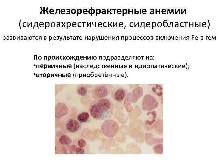 Железорефрактерные анемии (сидероахрестические, сидеробластные) развиваются в результате нарушения процессов включения Fe в гем По