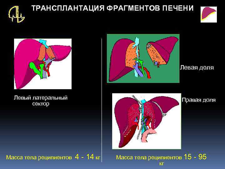 Можно ли пересадить печень. Техника ортотопической трансплантации печени. Трансплантация печени схема. Трансплантация части печени. Трансплантация печени операция.