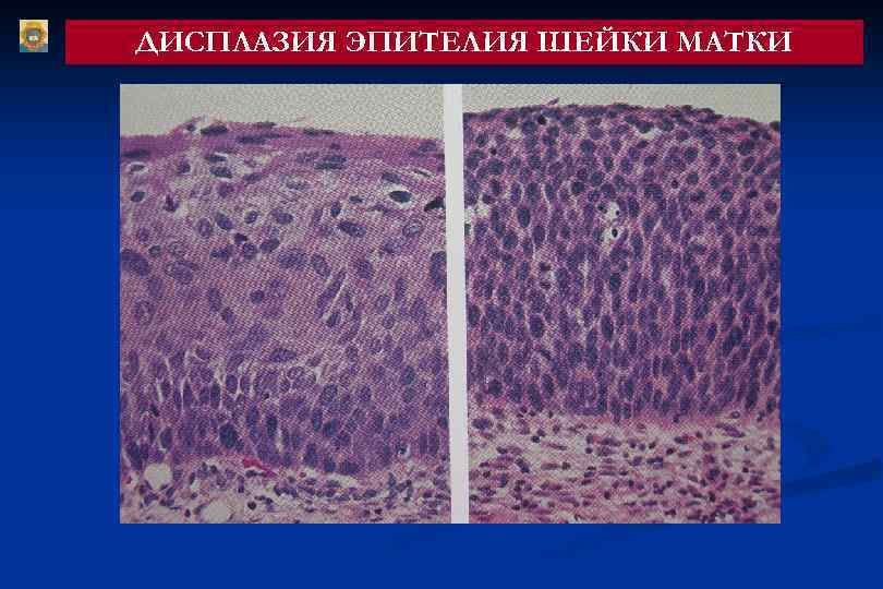 Регенерации слизистой оболочки. Плоскоклеточная метаплазия эпителия. Метаплазированный эпителий шейки. Метаплазия гистология. Дисплазия слизистой оболочки шейки матки.
