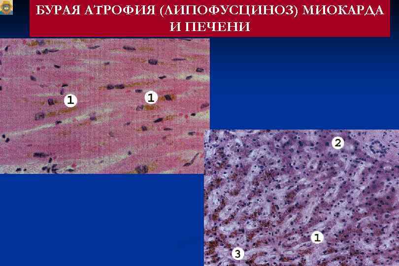 БУРАЯ АТРОФИЯ (ЛИПОФУСЦИНОЗ) МИОКАРДА И ПЕЧЕНИ 