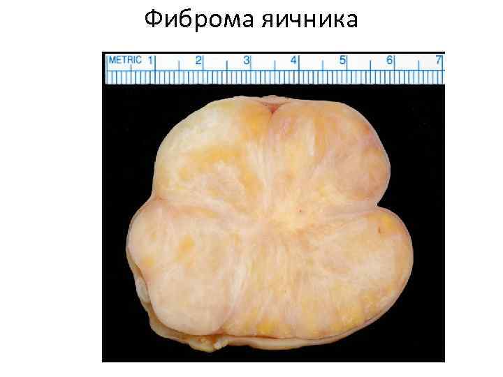 Фиброма яичника 