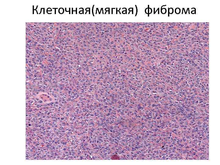 Клеточная(мягкая) фиброма 