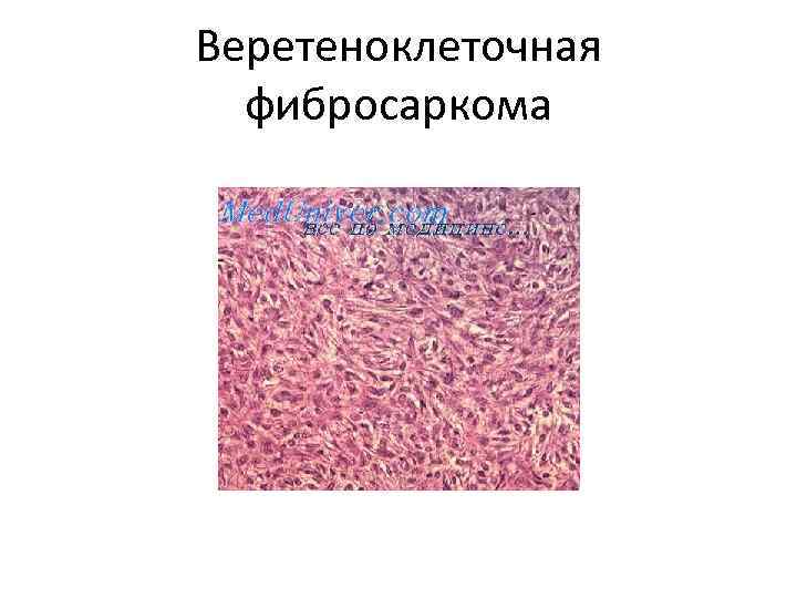 Веретеноклеточная фибросаркома 