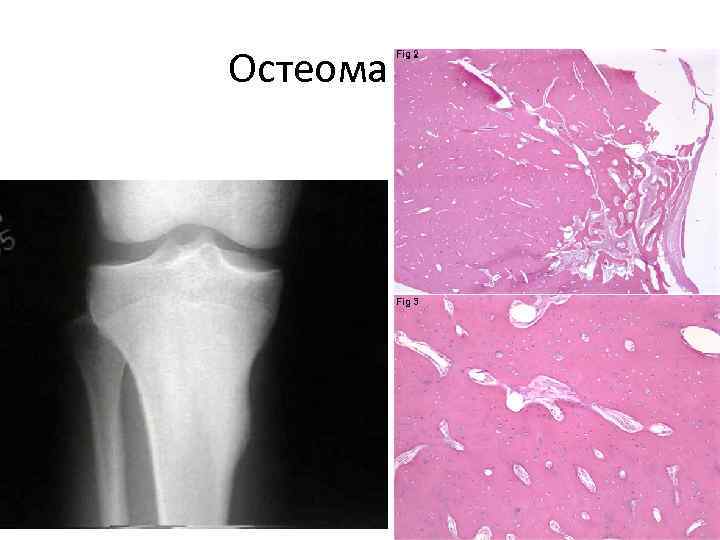 Компактная остеома фото