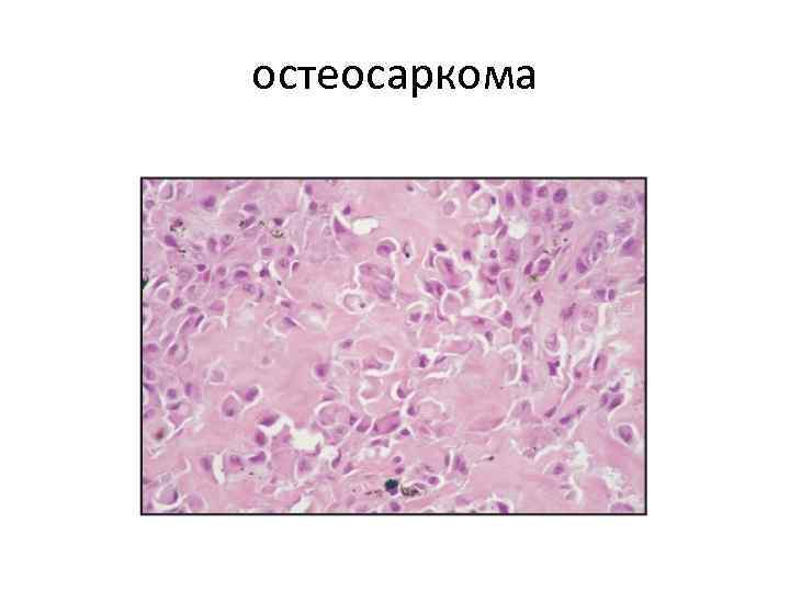 Фибросаркома микропрепарат рисунок