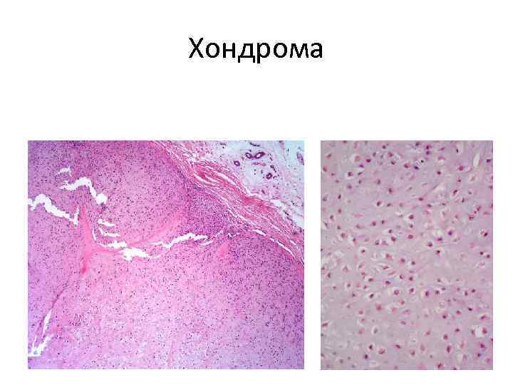 Хондрома микропрепарат рисунок