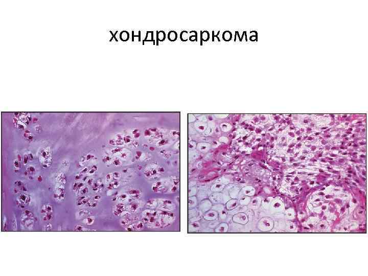 Хондрома микропрепарат рисунок