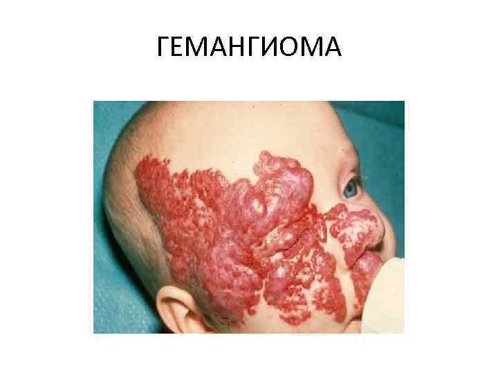 ГЕМАНГИОМА 