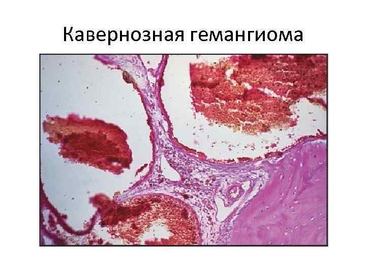 Кавернозная гемангиома 