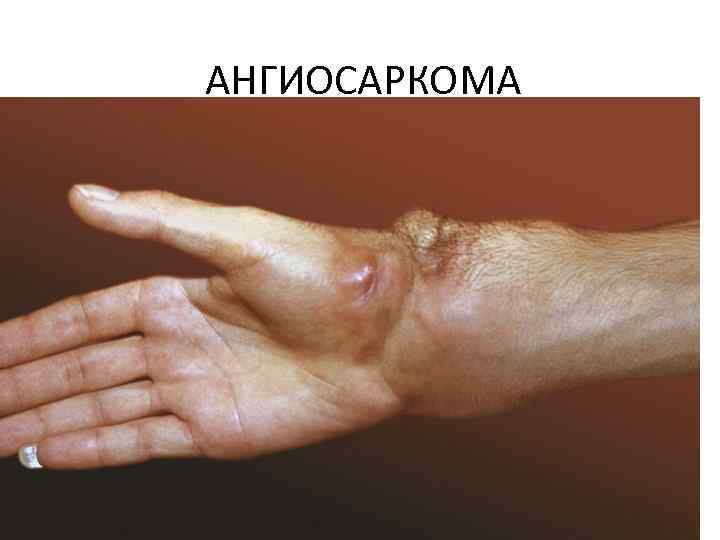 АНГИОСАРКОМА 