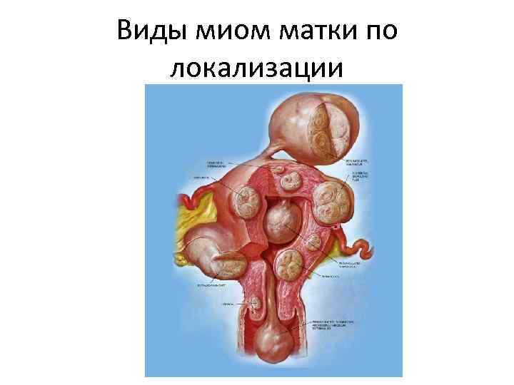 Виды миом матки по локализации 