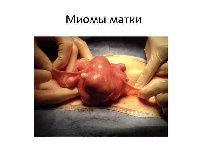 Миомы матки 