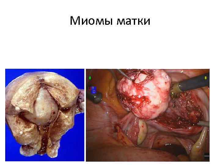 Миомы матки 