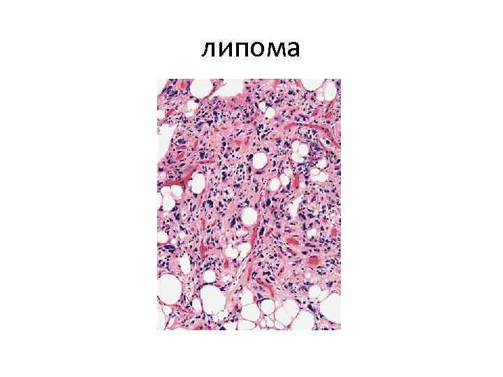 липома 