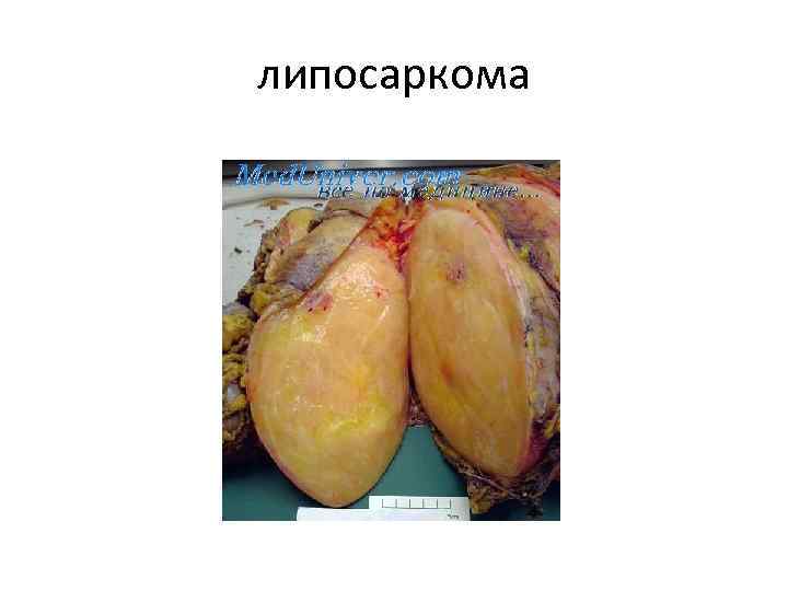 липосаркома 