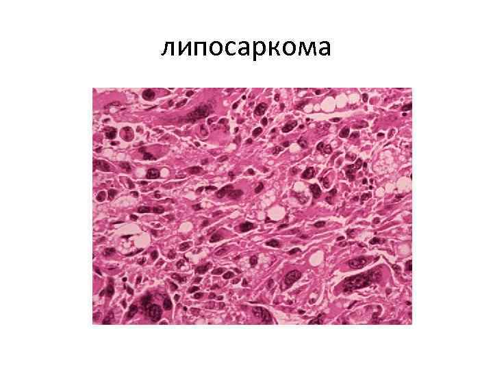 липосаркома 