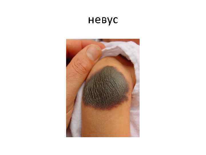 невус 