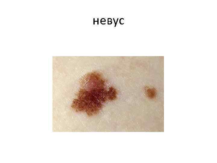 невус 