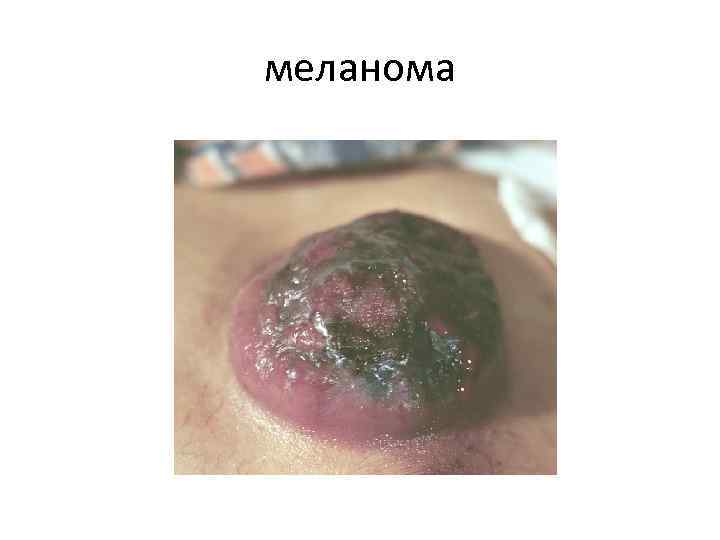 меланома 