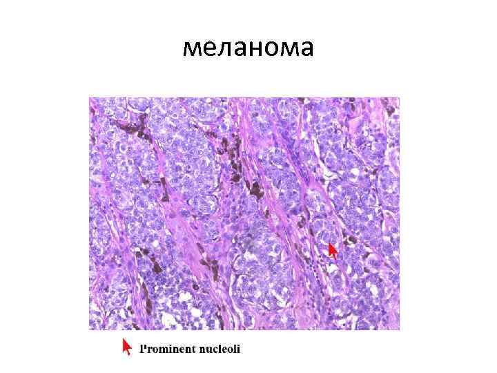 меланома 