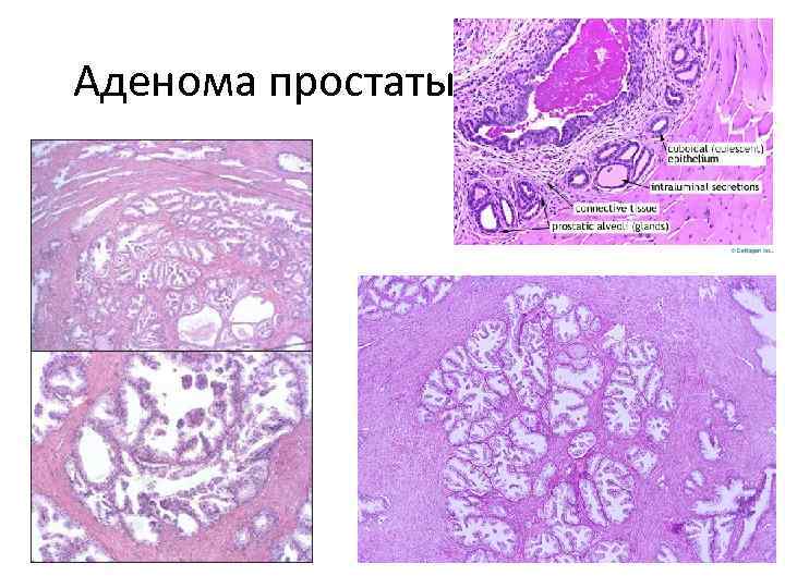 Аденома простаты 