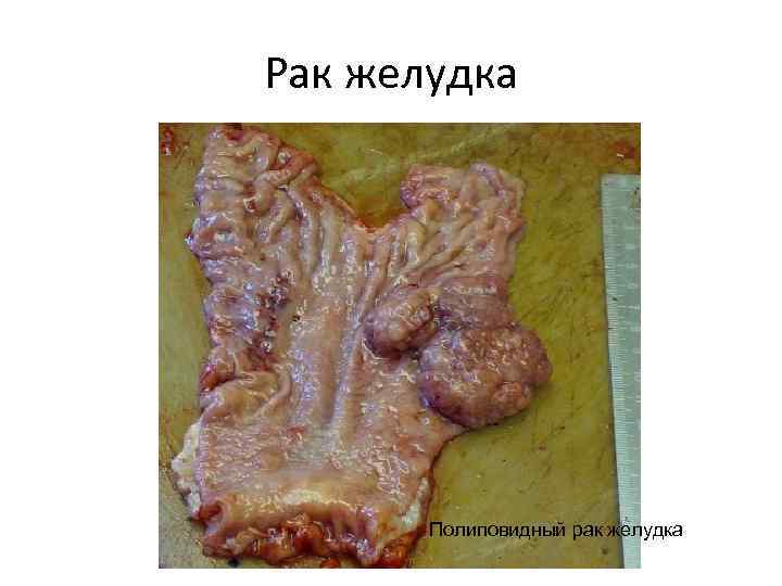 Рак желудка Полиповидный рак желудка 