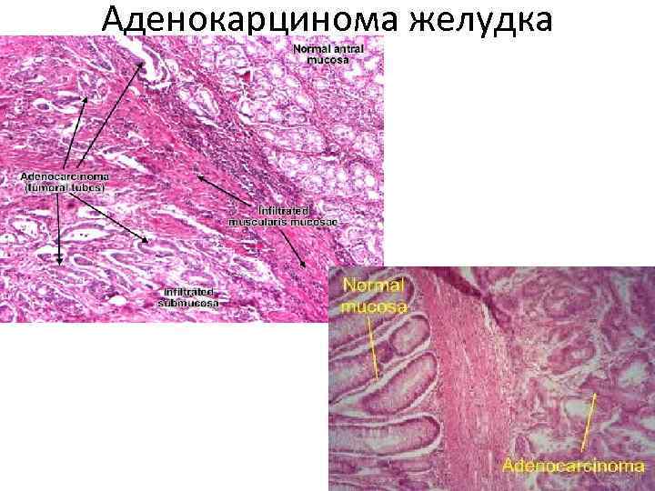 Аденокарцинома желудка 