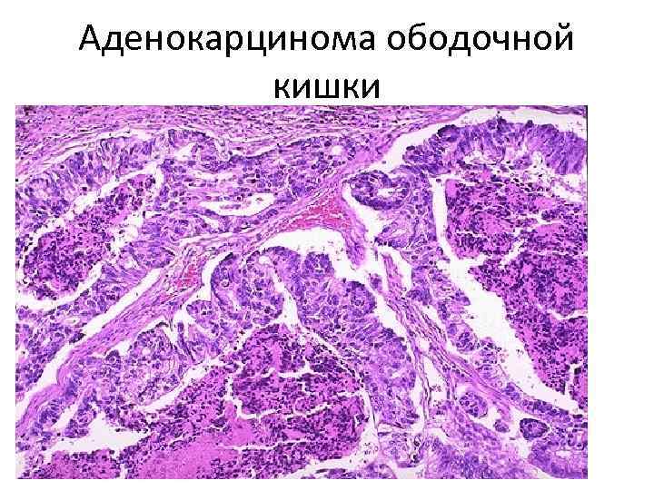 Аденокарцинома ободочной кишки 