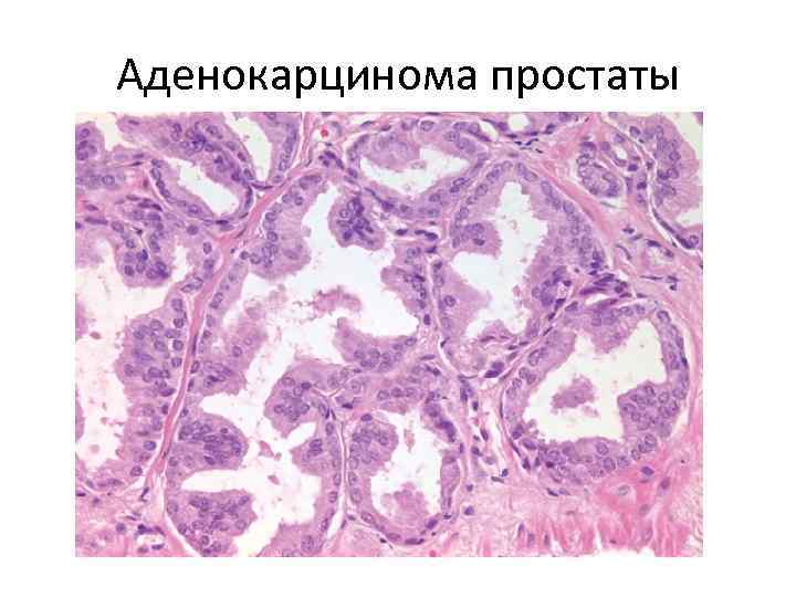 Аденокарцинома простаты 