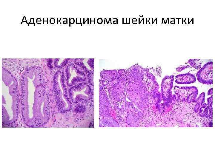 Аденокарцинома шейки матки 