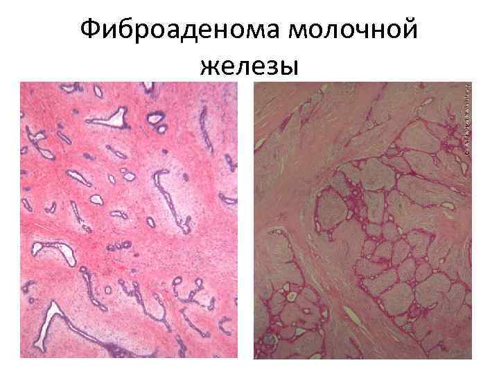 Фиброаденома молочной железы 