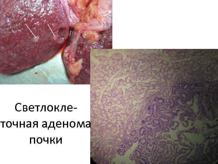 Светлоклеточная аденома почки 