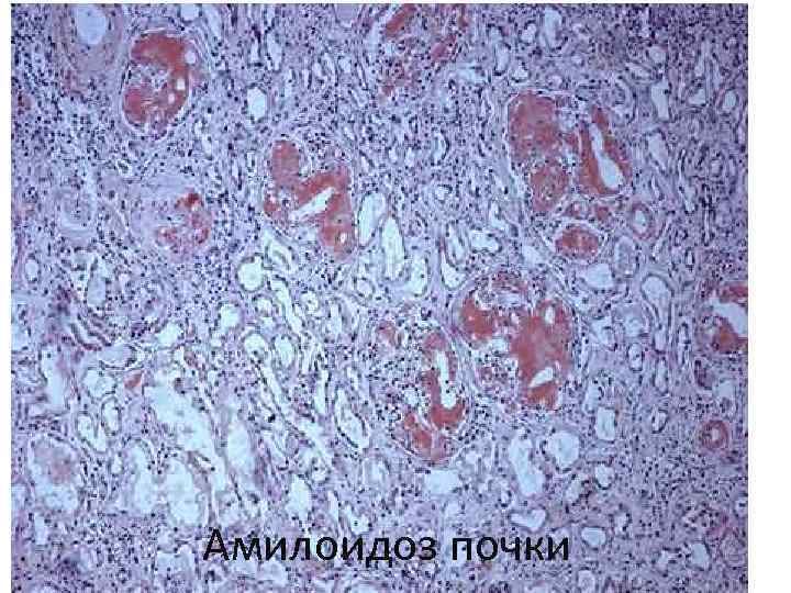 Амилоидоз почки 