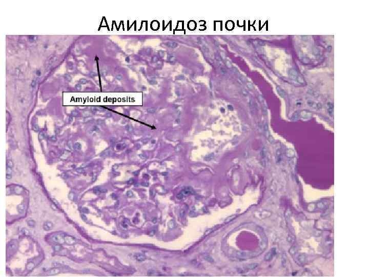 Амилоидоз почки 