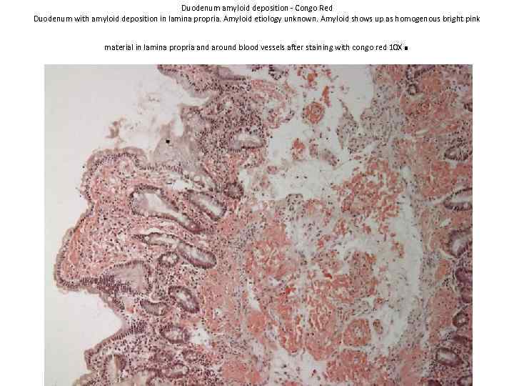 Duodenum amyloid deposition - Congo Red Duodenum with amyloid deposition in lamina propria. Amyloid