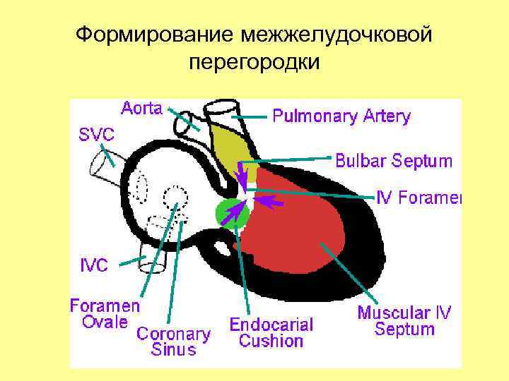 Формирование межжелудочковой перегородки 