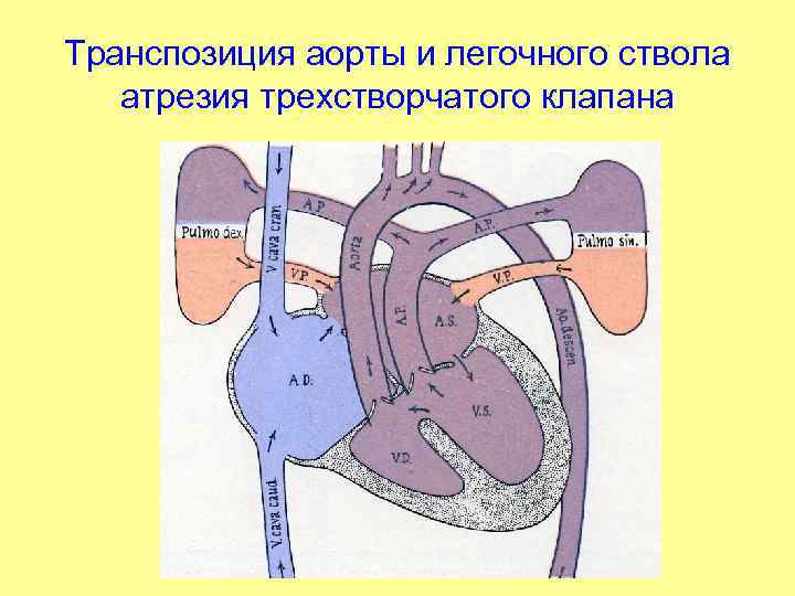 Транспозиция аорты и легочного ствола атрезия трехстворчатого клапана 