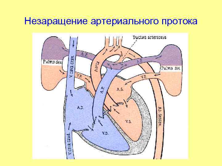 Незаращение артериального протока 