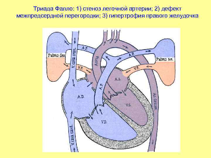 Триада Фалло: 1) стеноз легочной артерии; 2) дефект межпредсердной перегородки; 3) гипертрофия правого желудочка