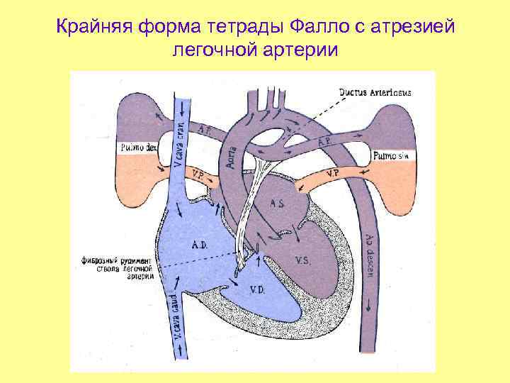 Крайняя форма тетрады Фалло с атрезией легочной артерии 