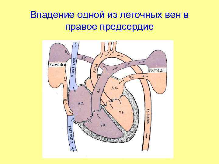 Впадение одной из легочных вен в правое предсердие 