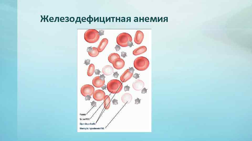 Железодефицитная анемия патофизиология презентация