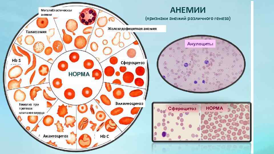 АНЕМИИ Мегалобластическая анемия (признаки анемий различного генеза) Железодефицитная анемия Талассемия Анулоциты Hb S Сфероцитоз