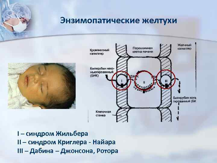 Энзимопатические желтухи I – синдром Жильбера II – синдром Криглера - Найара III –