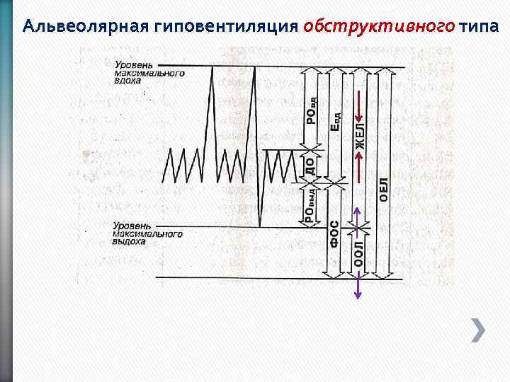Альвеолярная гиповентиляция обструктивного типа 