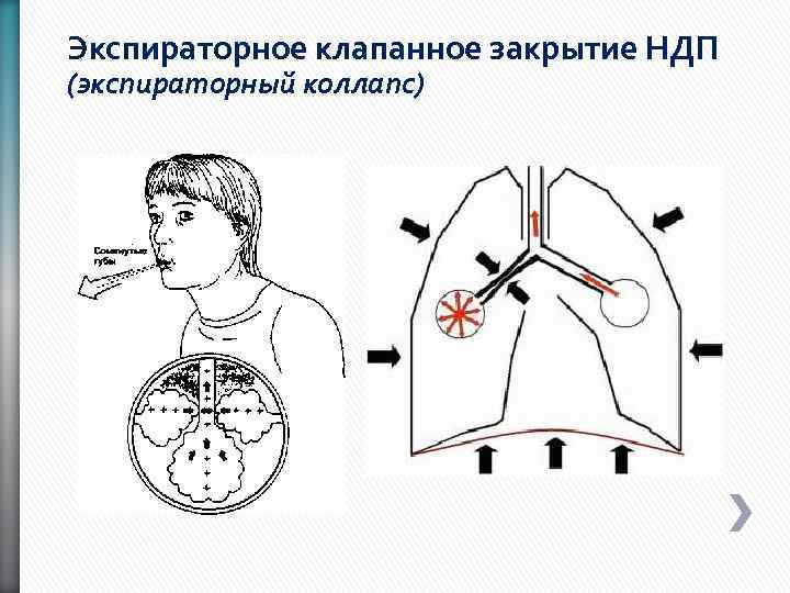 Экспираторное клапанное закрытие НДП (экспираторный коллапс) 